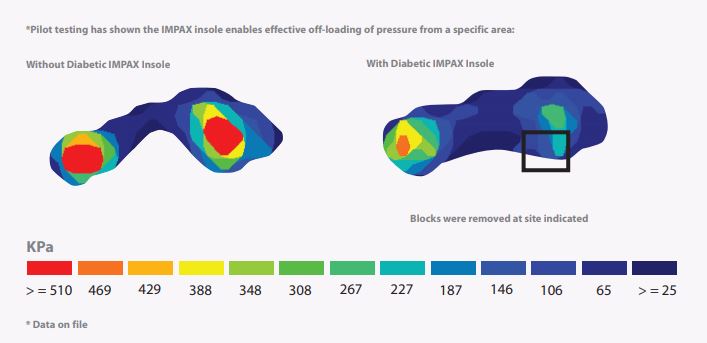 The Impax Grid Insole Offloads Pressure From a Specific Area