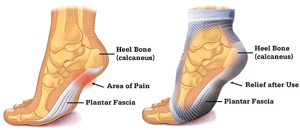Pain-Relieving Effects of the OrthoSleeve FS6 Plantar Fasciitis Foot Sleeves